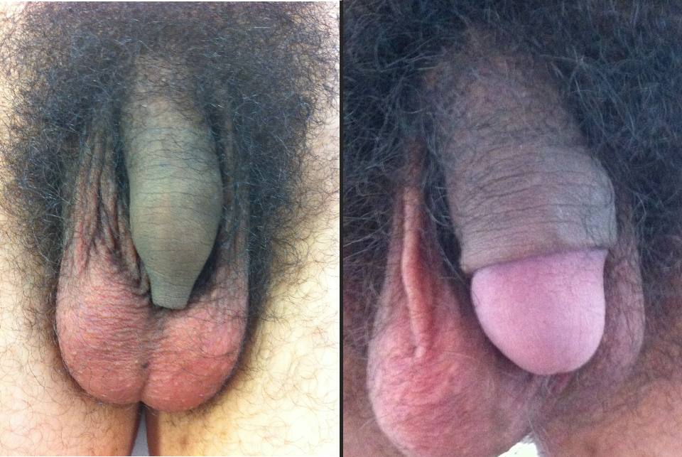 PREPUCE LONG avant / après circoncision
