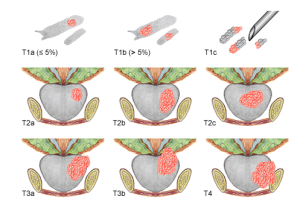 classification-tmn-cancer-prostate