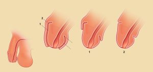 Schéma explicatif sur les différentes circoncisions