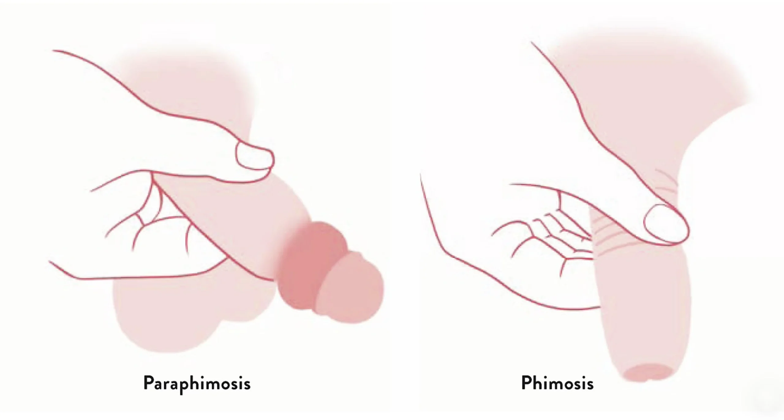 Schéma comparatif du phimosis et du paraphimosis