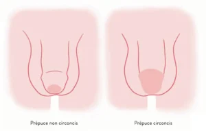 Prépuce et circoncision : schéma avant et après